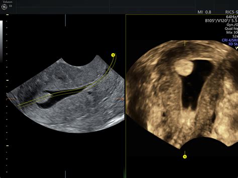 ultrasound for uterine polyps